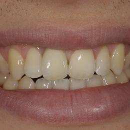 Efekty leczenia dentystycznego - 4_54fd88729b422.JPG